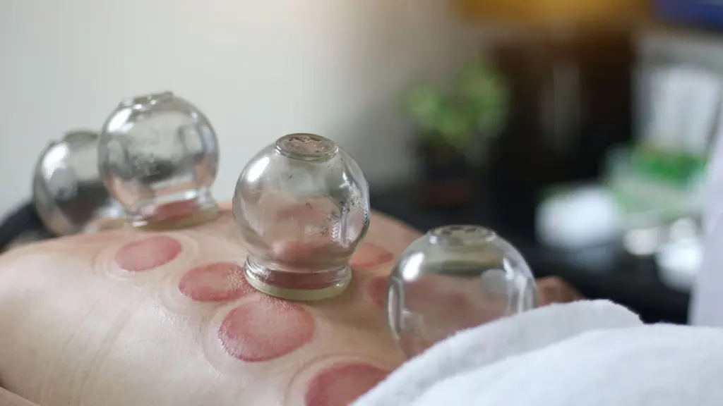 Aplicação de ventosas de vidro sobre as costas, numa sessão de medicina tradicional chinesa